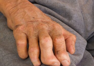 Leprosy is on the rise in the US and could be endemic in Florida, report says
